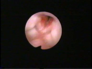 ANGIOMA SUBGLOTICO ANGIOMA SUBGLOTICO