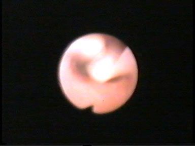LARINGOMALACIA LARINGOMALACIA